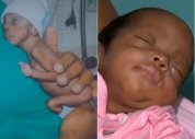 Bebê que nasceu aos 5 meses é literalmente um milagre, diz médica