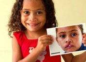 Operação Sorriso seleciona pacientes para cirurgia em Maceió